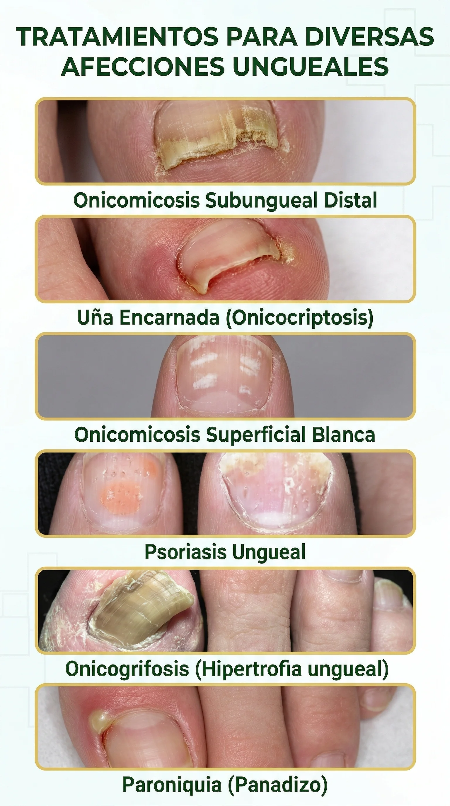 Elimina Los Hongos de Raíz